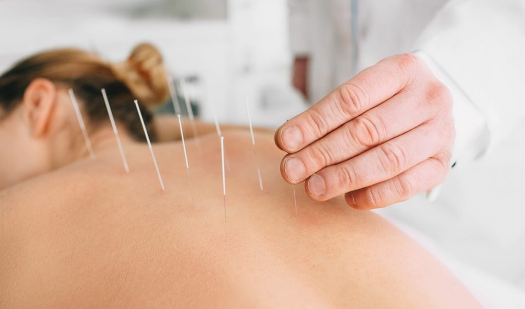 Acupuncture : comment cela fonctionne exactement ?