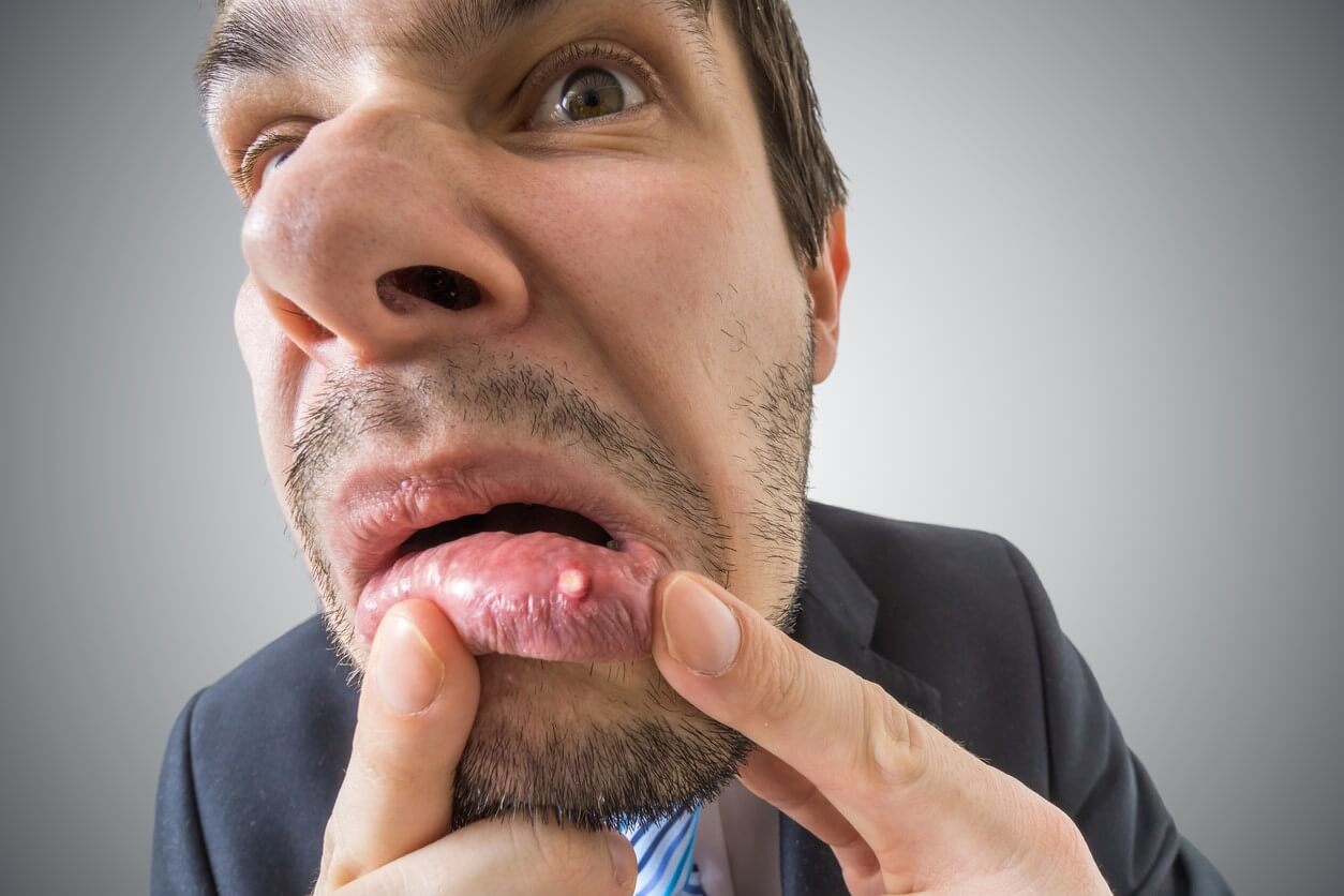 Aphte qui dure longtemps à cause du stress : que faire ? - Stress.app
