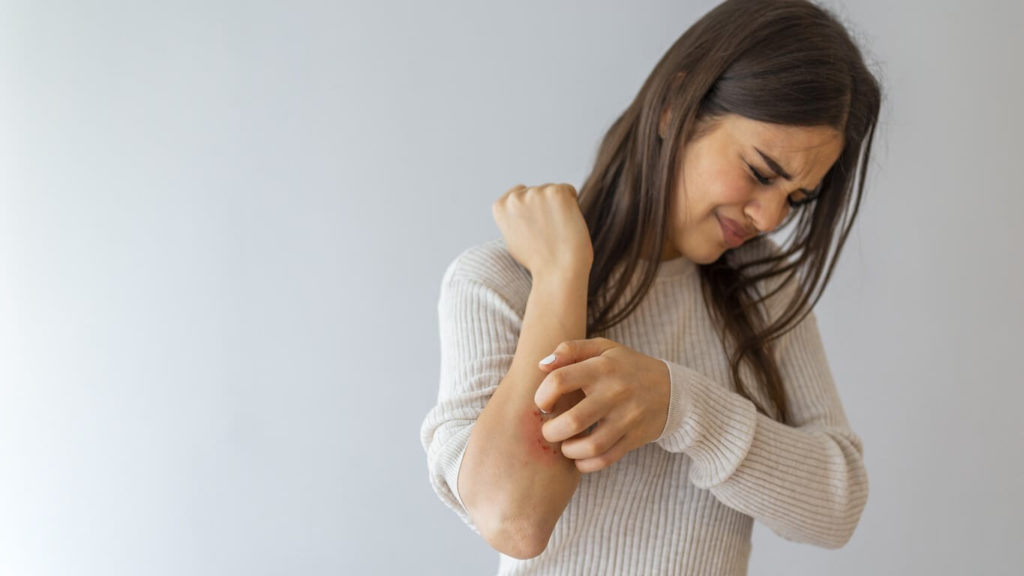 Eczema: les solutions pour se soigner naturellement?
