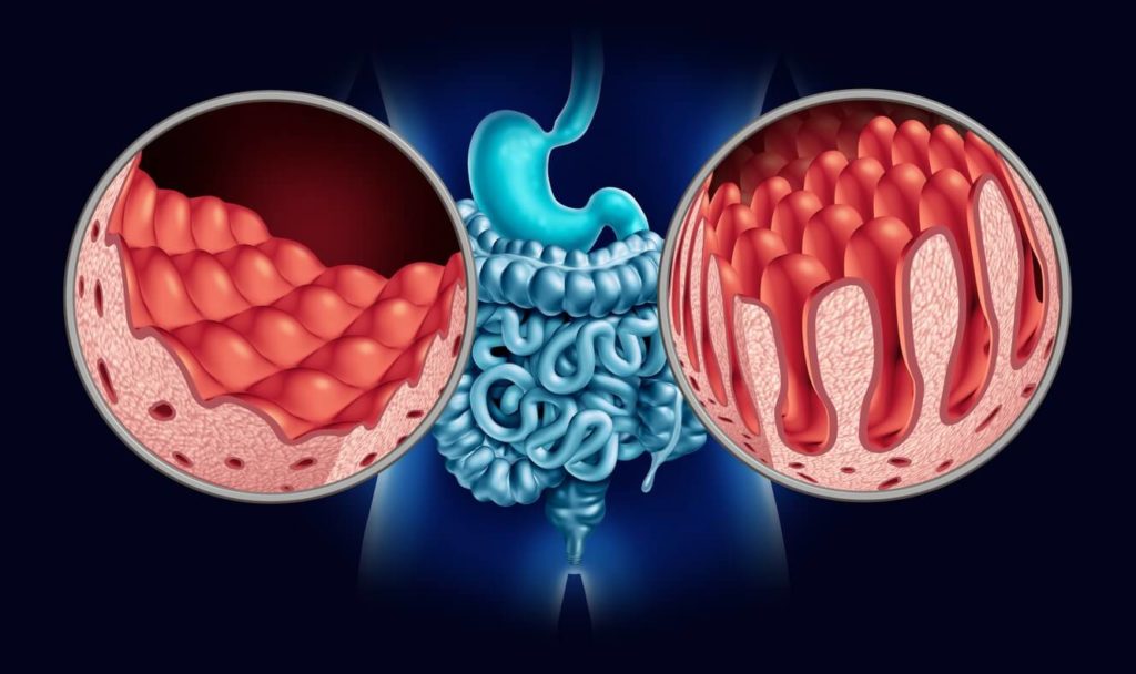 Maladie Coeliaque: comment régénérer son intestin?
