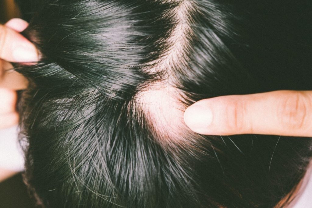 Alopecia: ¿como darte un capricho para dejar de perder cabello?