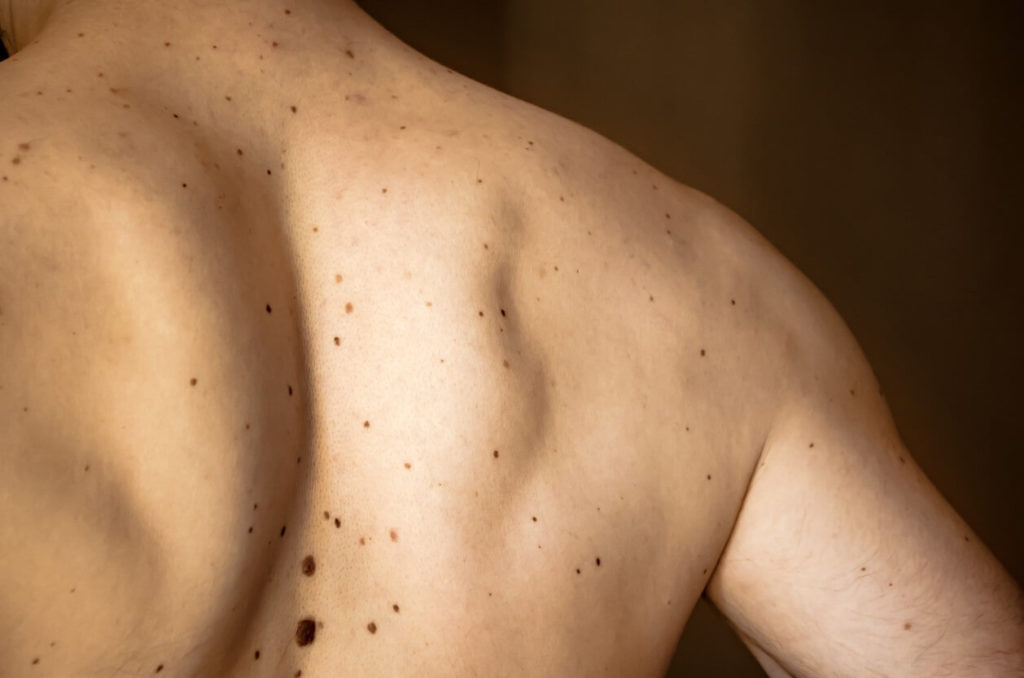 Skin cancer: symptoms and causes?