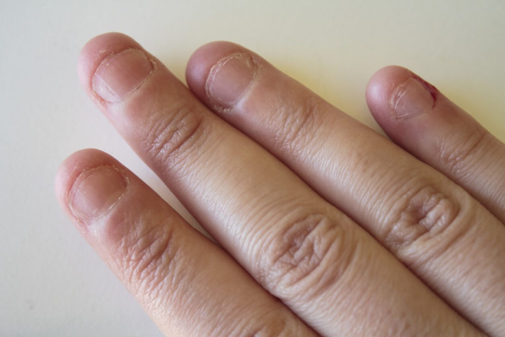 Onychophagie et stress : comment arrêter de se ronger les ongles ?