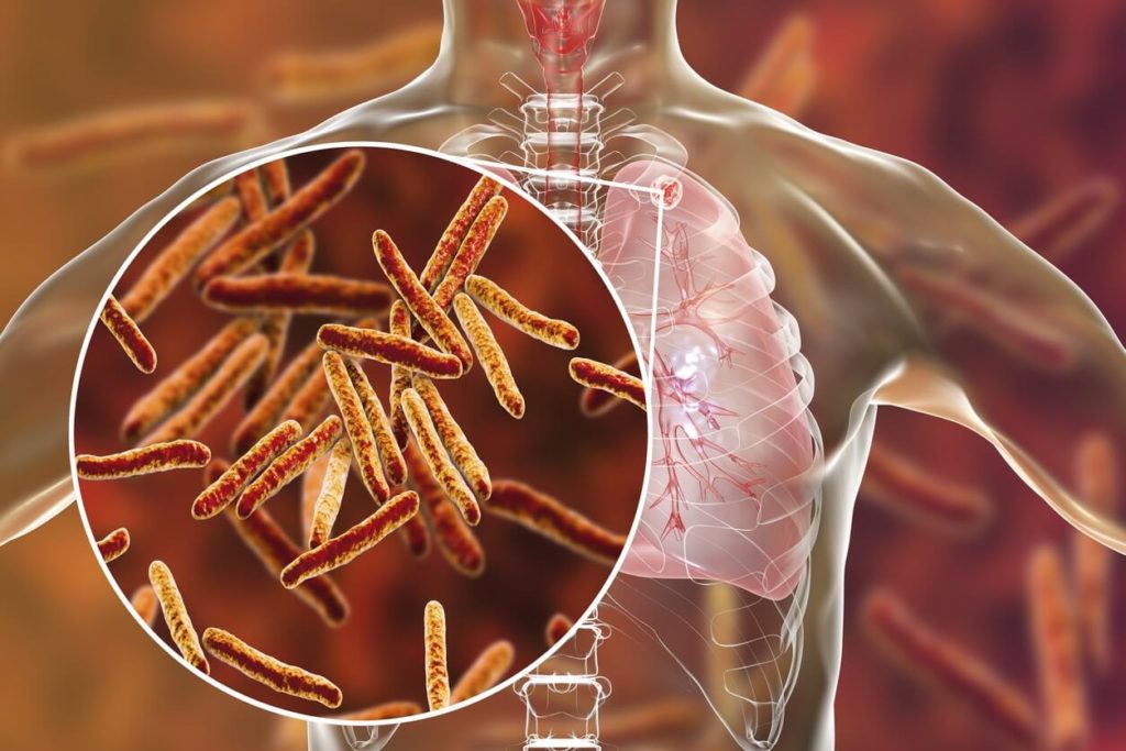 Tuberculose: comment guérir naturellement?