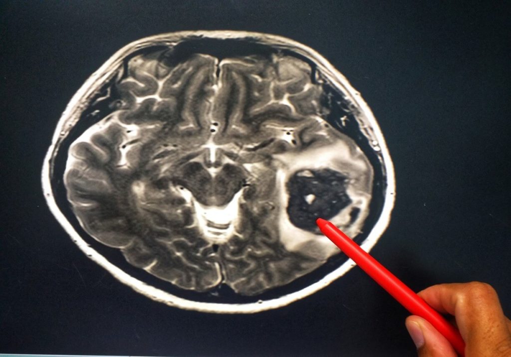 Tumeur au cerveau : quelles solutions pour se soigner ?