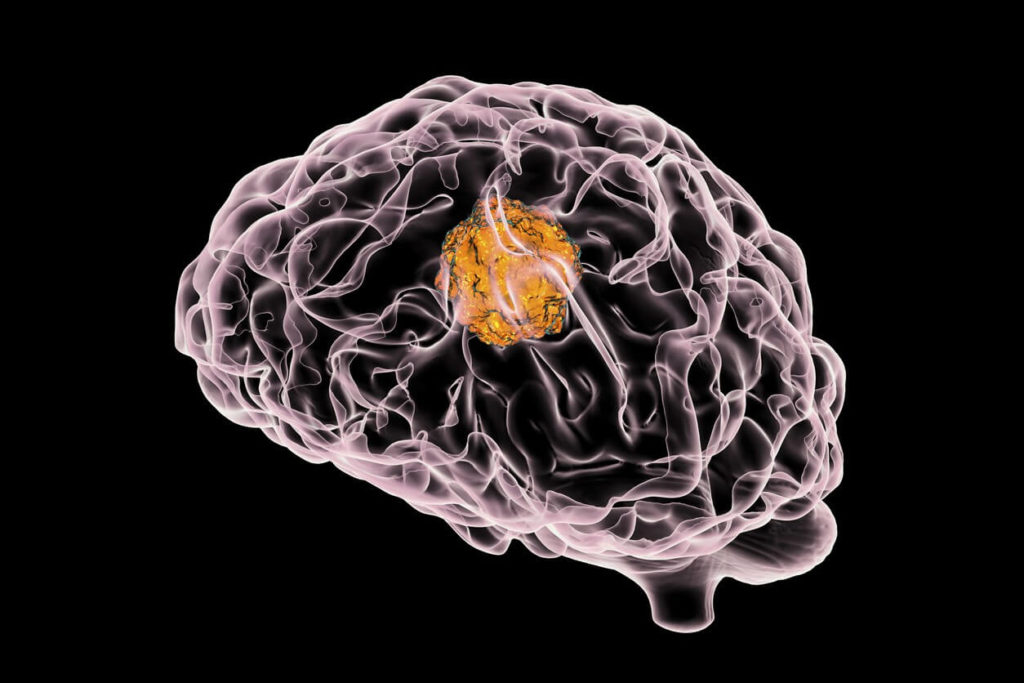 Tumeur cérébrale: quand le cerveau dit stop au stress!