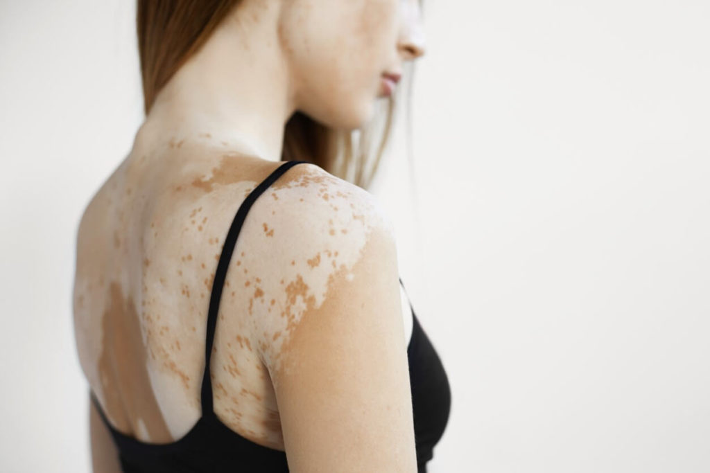 Vitiligo: como se tratar naturalmente?