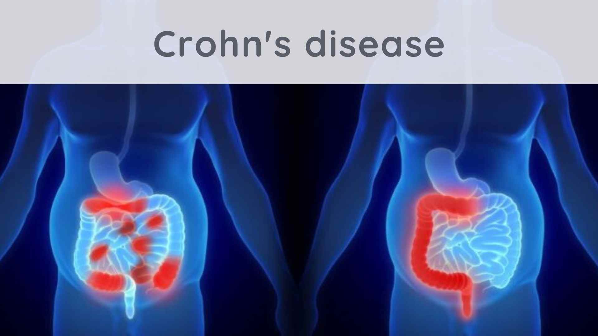 Crohn's Disease: What Solutions? - Stress.app