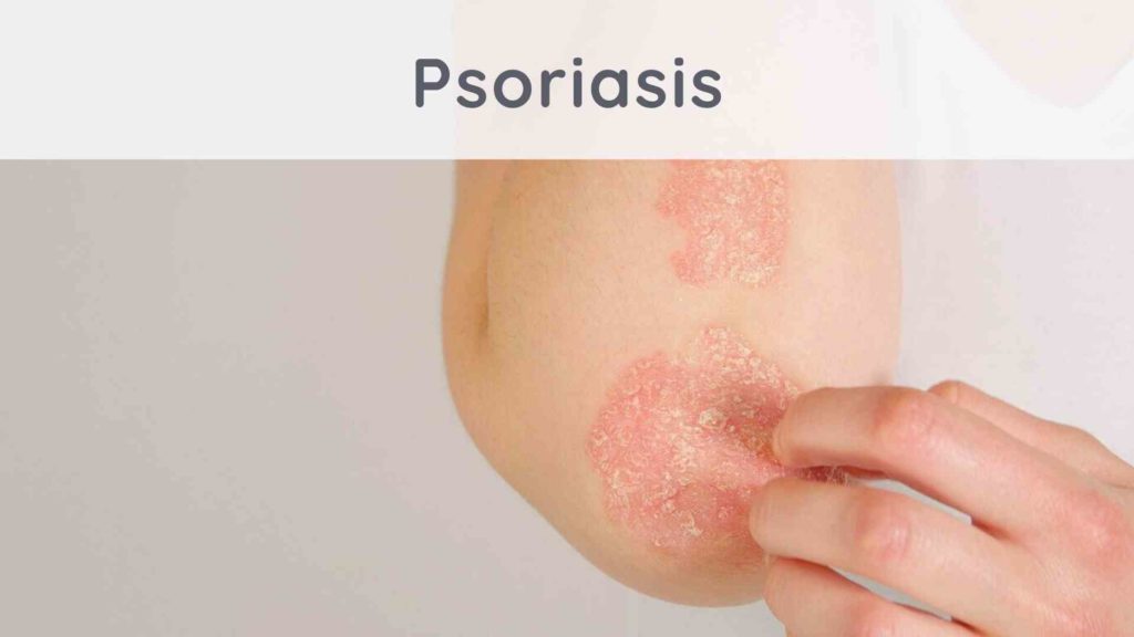 Psoriasis vulgaris g Possible complications for psoriasis