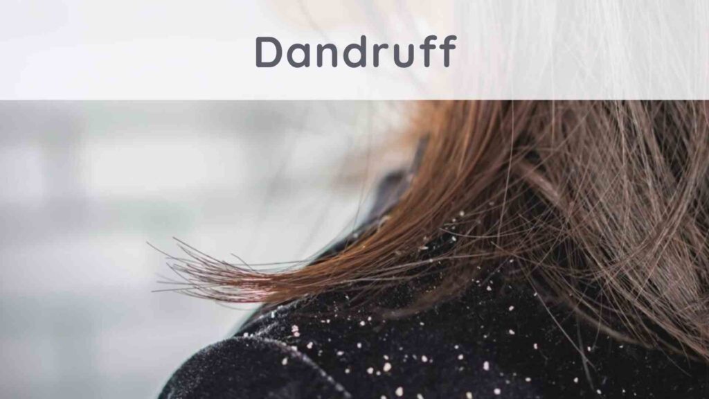 Dandruff: how to get rid of it naturally?