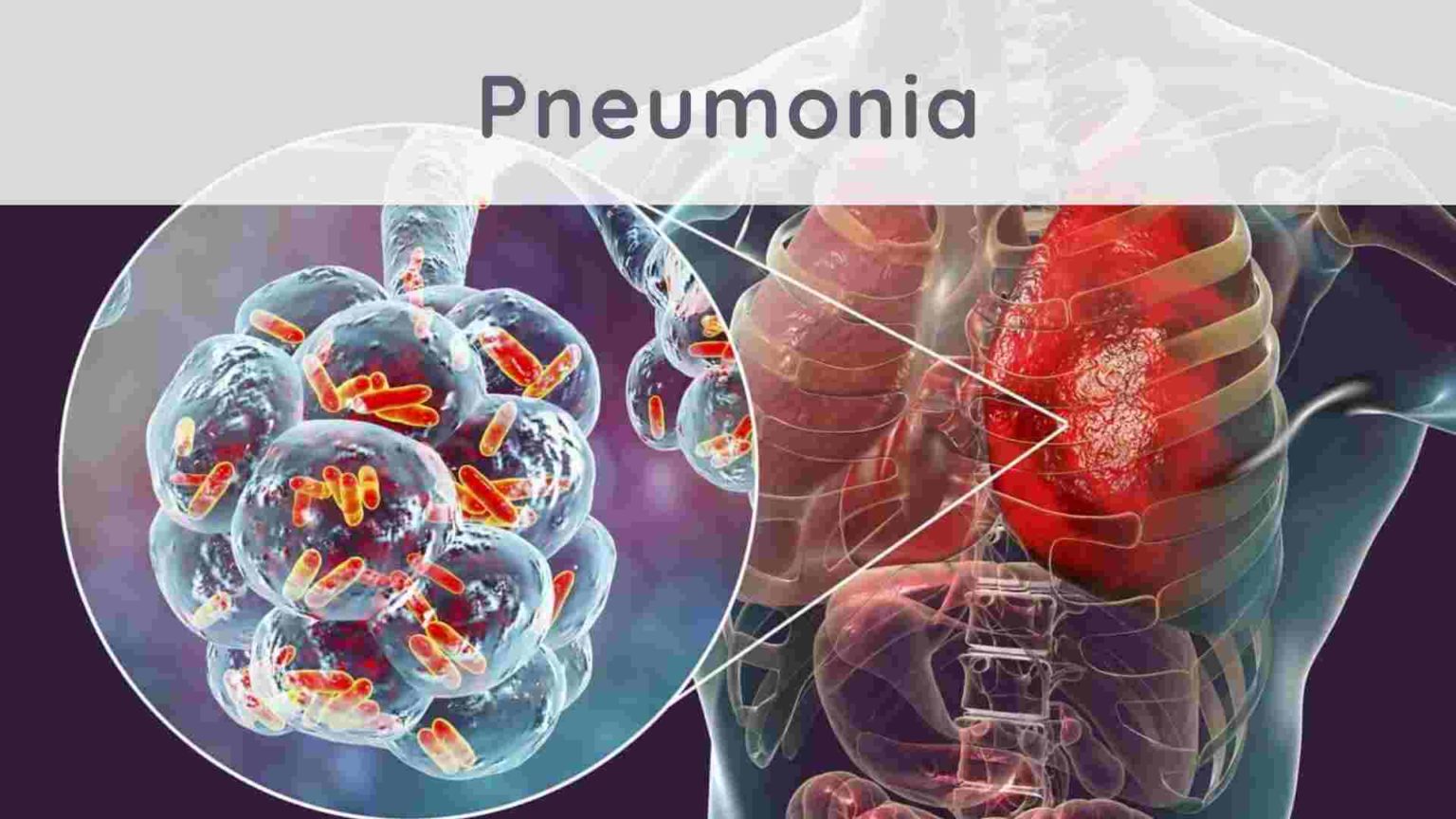Pneumonia how to treat it naturally? Stress.app