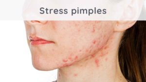 Stress pimples : what solutions to eliminate them ?